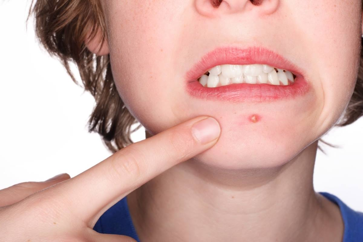 Hướng dẫn các bước trị mụn ở cằm