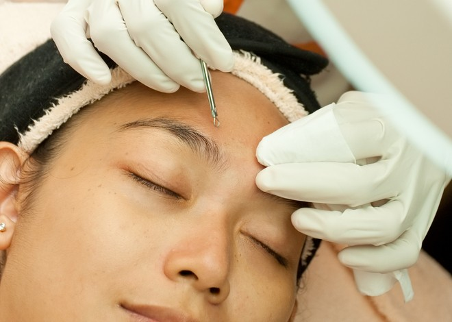 Tại sao bạn tuyệt đối không nên dùng cây nặn mụn tại nhà