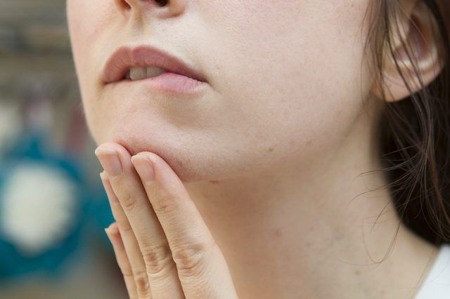 8 mẹo giúp ngăn ngừa và điều trị mụn nội tiết tố