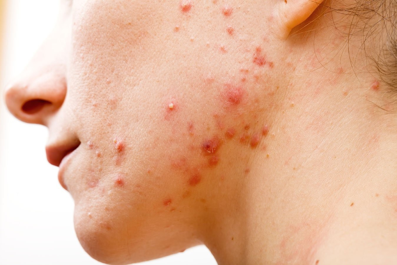 Hướng Dẫn Cách Trị Mụn Trứng Cá Dạng Nang Hiệu Quả