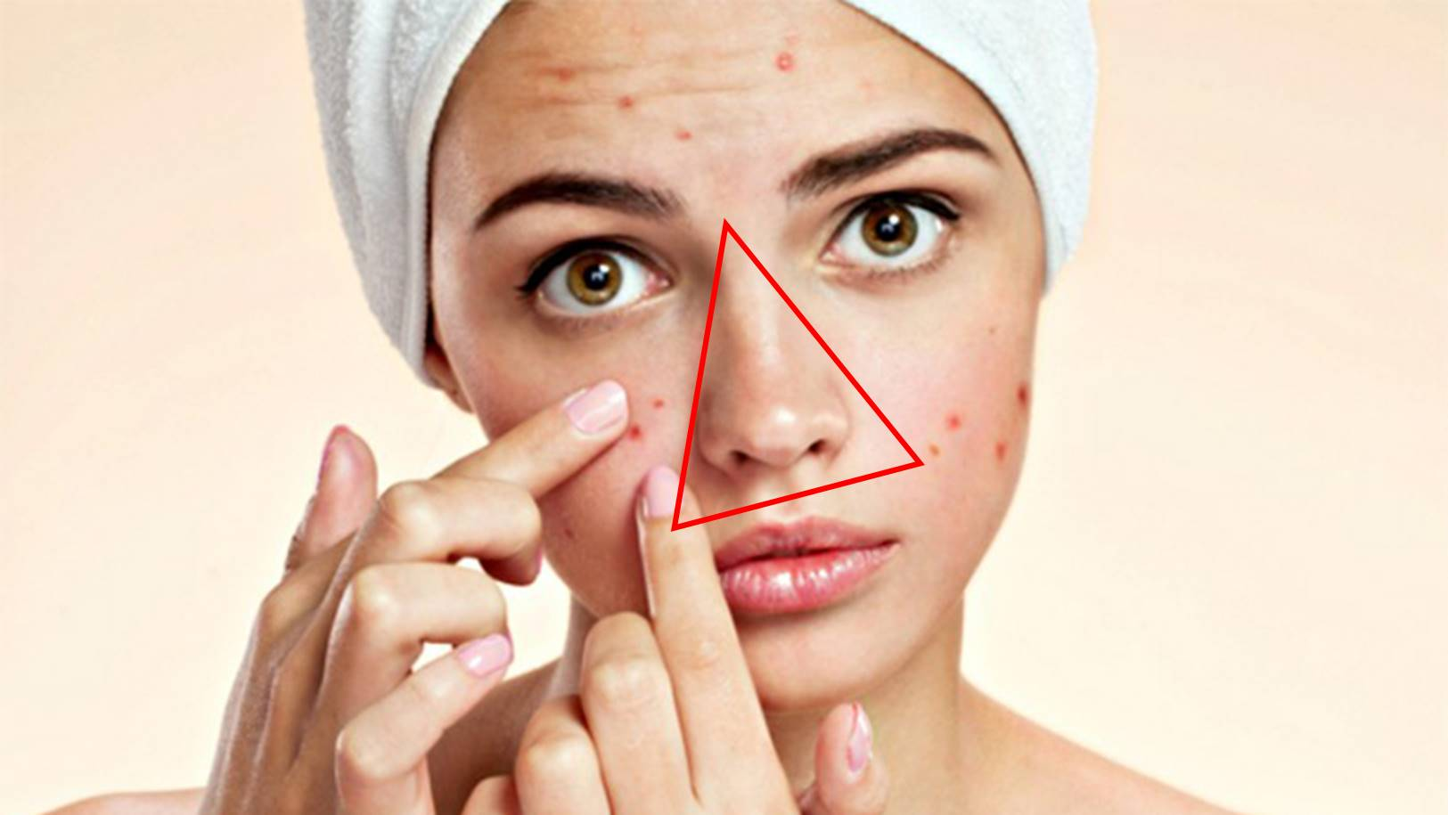 Mụn Nổi Ở Vùng Tam Giác Trên Mặt Có Thể Gây Tử Vong?