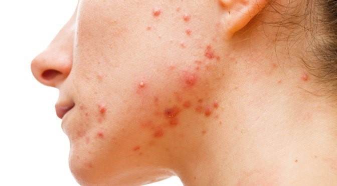 Hướng Dẫn Trị Và Ngăn Ngừa Mụn Nội Tiết Cho Da Nhạy Cảm