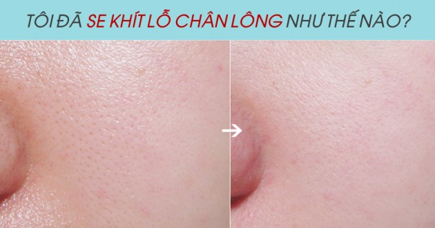 Tổng hợp các mẹo se khít lỗ chân lông được chia sẻ bởi độc giả Happy Skin