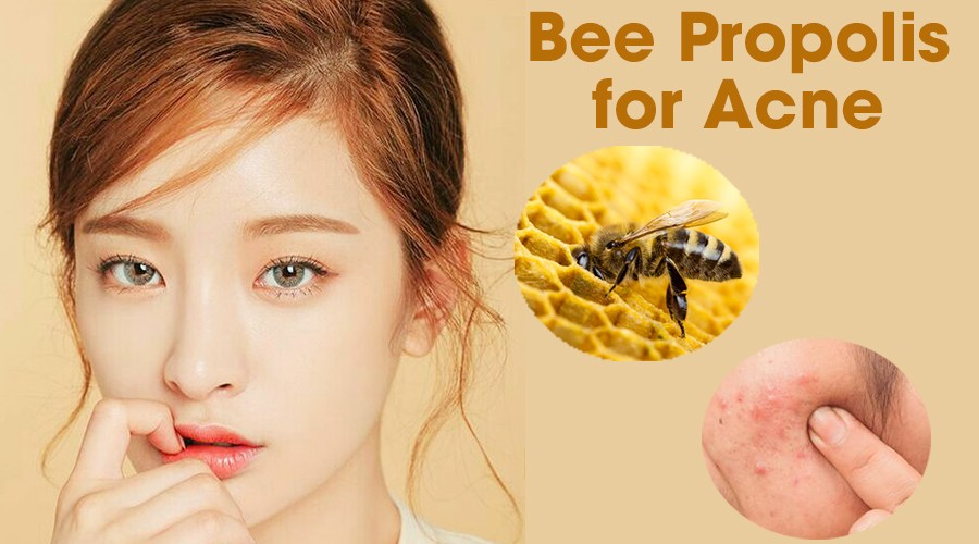Trước khi quyết định dùng Keo ong (Bee Propolis) trị mụn, nhất định phải đọc những điều này