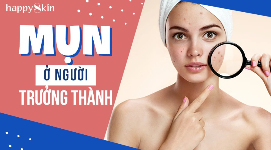 Những Nguyên Nhân Gây Ra Mụn Ở Người Trưởng Thành Và Cách Điều Trị