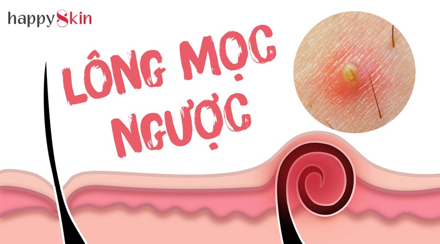 “Tất tần tật” những điều bạn phải biết nếu bị tình trạng “lông mọc ngược”