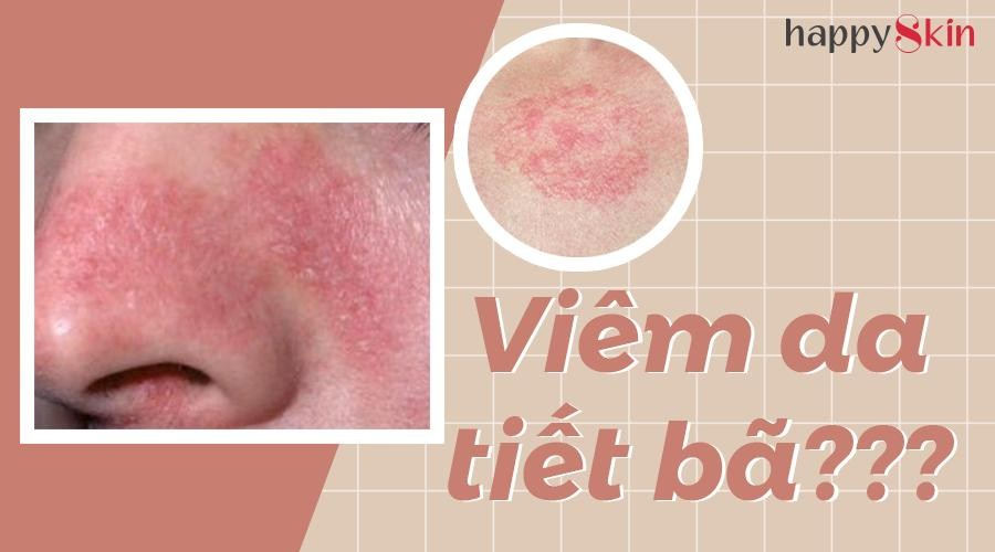Bệnh viêm da tiết bã và cách chăm sóc