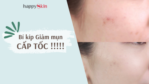Review chuẩn thật GEL GIẢM MỤN 3 tác động Emmié tận diệt nốt mụn cứng đầu