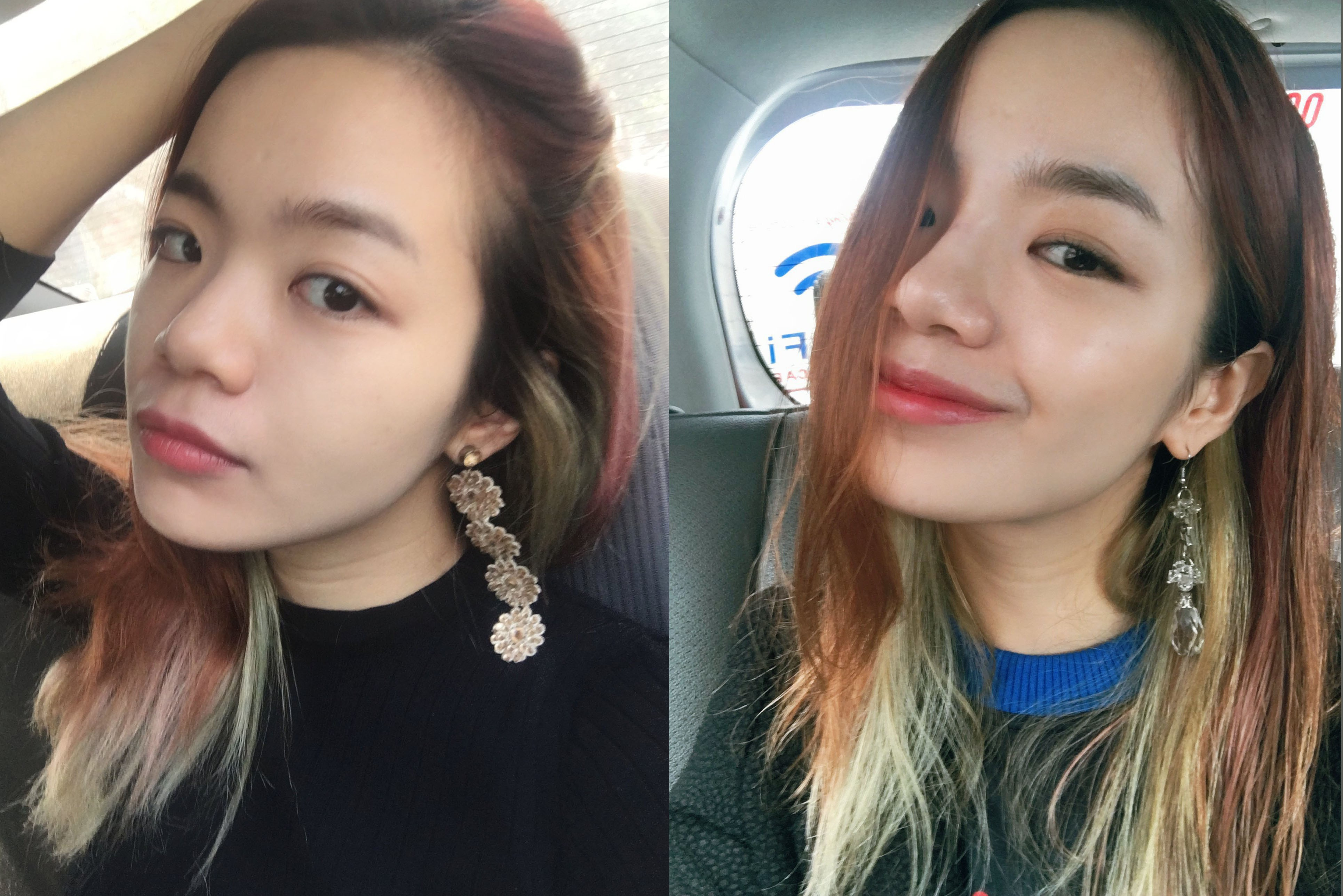 Có nên tiêm filler? Trải nghiệm thực tế từ một blogger