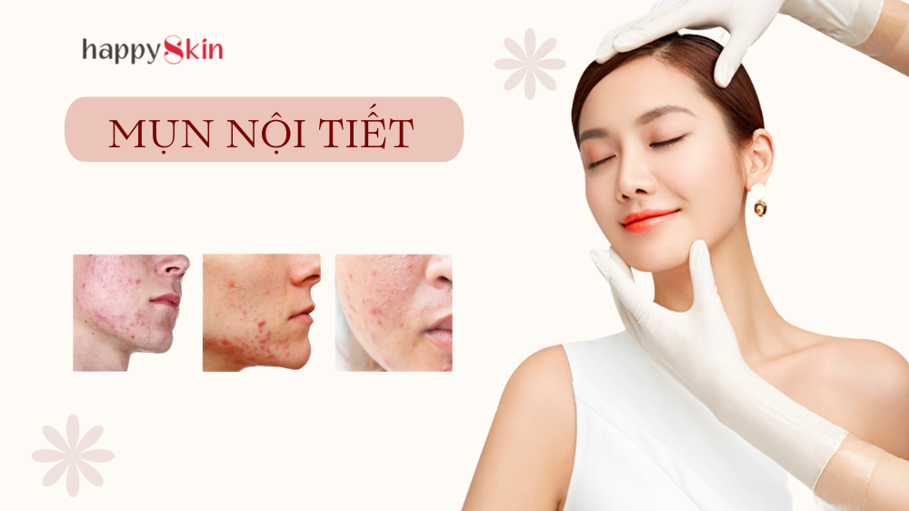 Đừng đổ thừa mụn nội tiết nếu không có 4 đặc điểm này