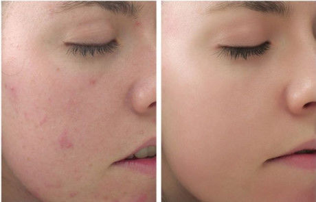 Niacinamide và Vitamin C giúp phục hồi da