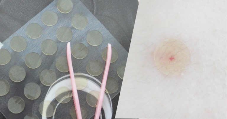 Review miếng dán mụn Nexcare – Bí kíp giảm mụn viêm mủ nhanh cấp tốc