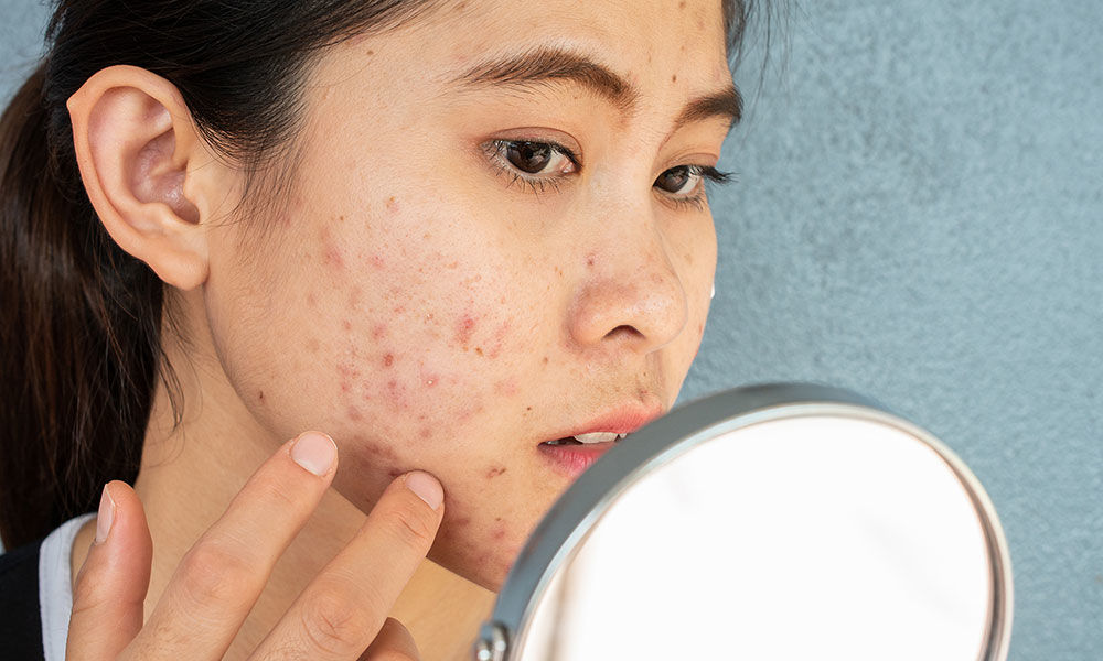 Lựa chọn thực phẩm chức năng hỗ trợ điều trị mụn như thế nào?