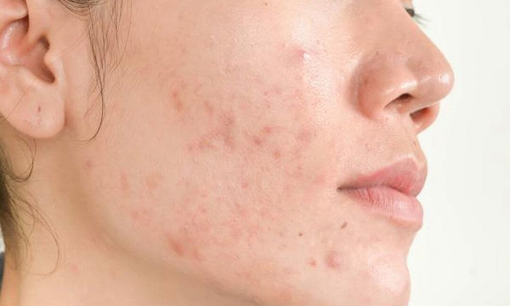 Thực phẩm chức năng hỗ trợ điều trị mụn là gì?