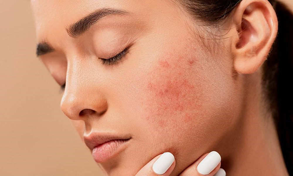 Lưu ý khi sử dụng thực phẩm chức năng hỗ trợ điều trị mụn