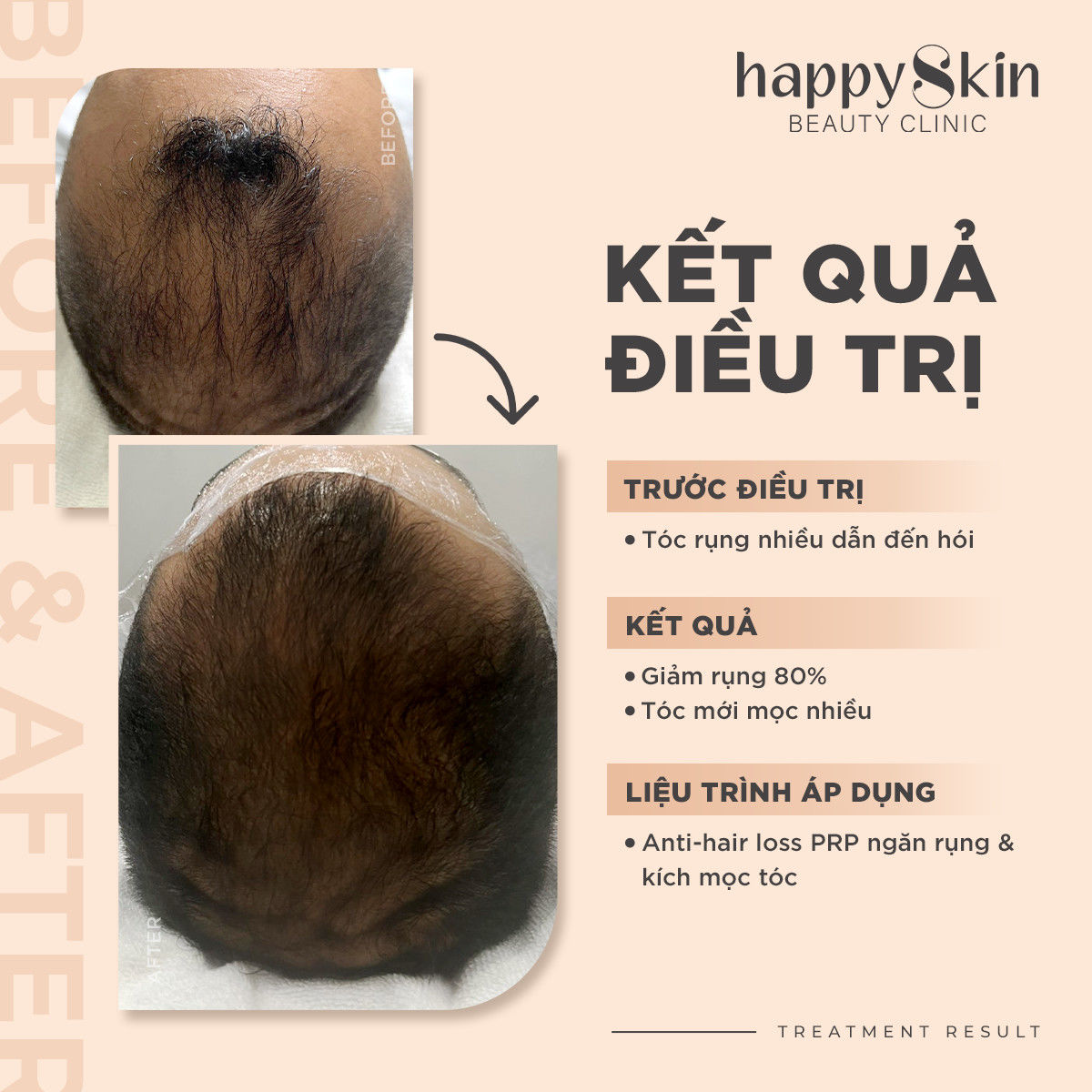 Kết quả điều trị - Anti-Hair PRP