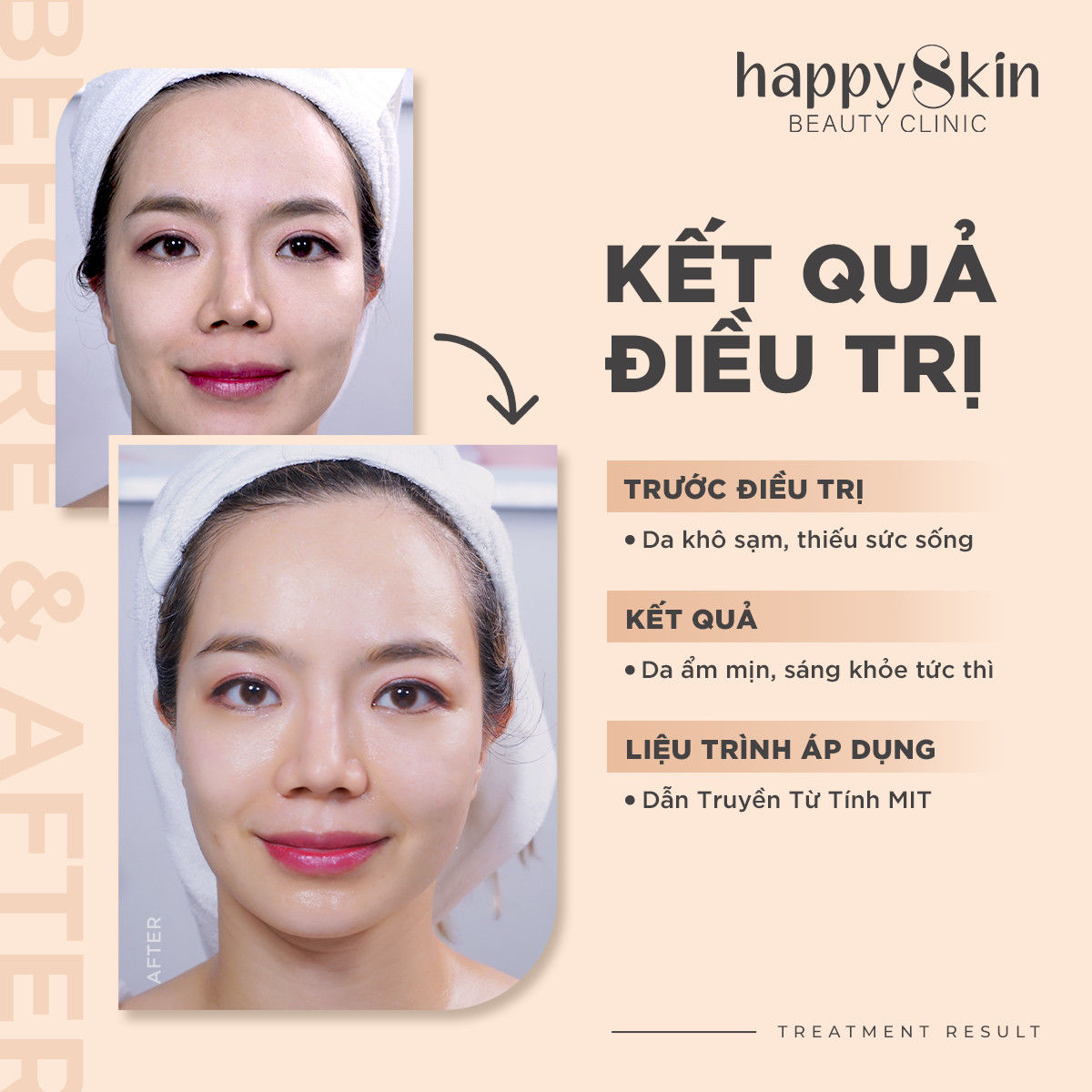Kết quả điều trị - Dẫn truyền từ tính MIT 1