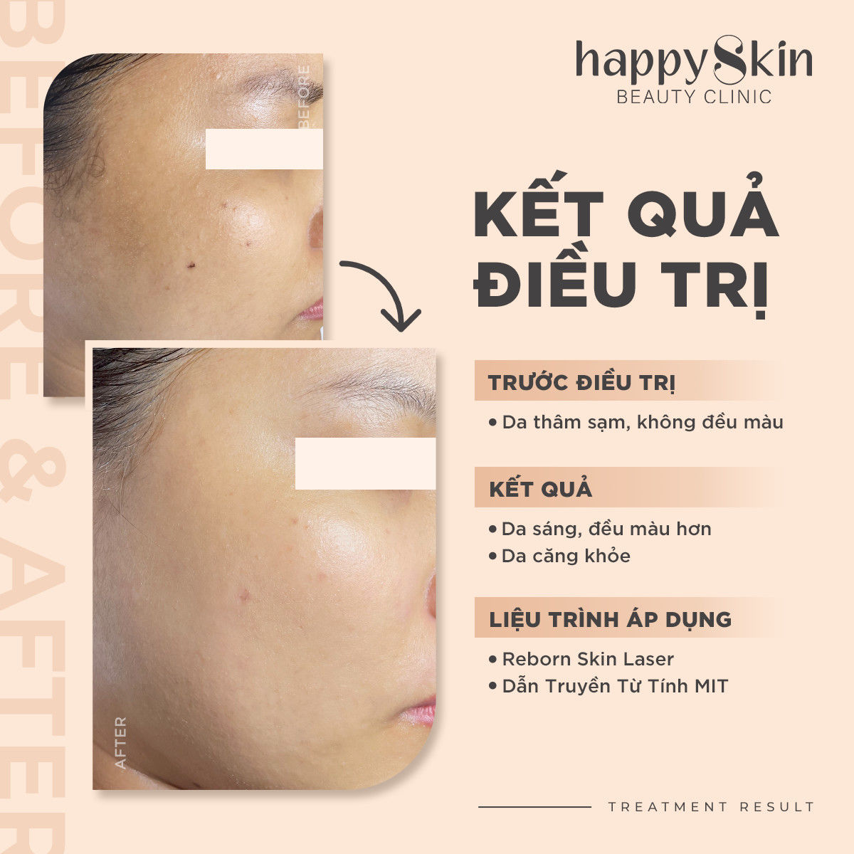 Kết quả điều trị - Dẫn truyền từ tính MIT + Reborn Skin Laser