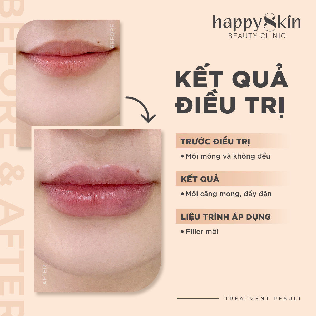 Kết quả điều trị - Filler môi