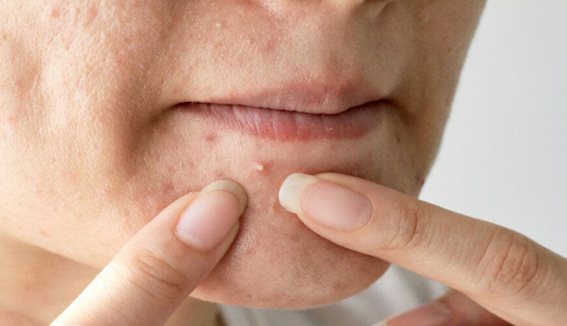 6 Nguyên Nhân Hàng Đầu Gây Ra Tình Trạng Da Dầu Bạn Biết Chưa?