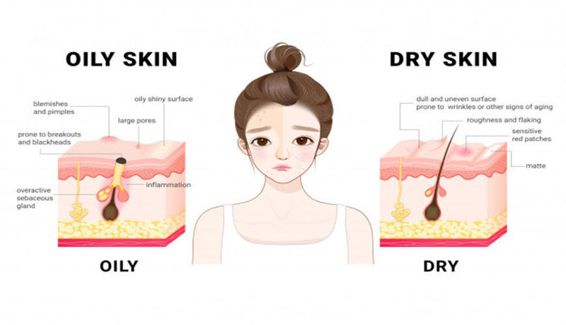 Đặc điểm của làn da dầu