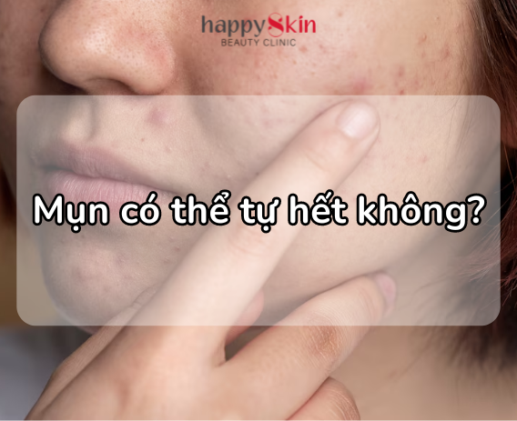 Mụn Có Tự Hết Được Không? Trị Mụn Bằng Công Nghệ Plasma Lần Đầu Tiên Xuất Hiện