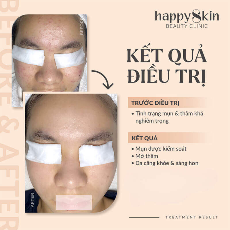 Những Lợi Ích Của Peel Da Trị Da Mụn Thâm Nám