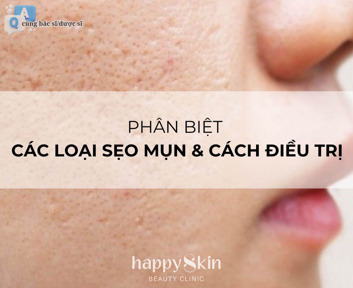 Làm Đẹp Cùng Bác Sĩ - Kỳ 6: Các Loại Sẹo Mụn Phổ Biến Và Cách Điều Trị Hiệu Quả