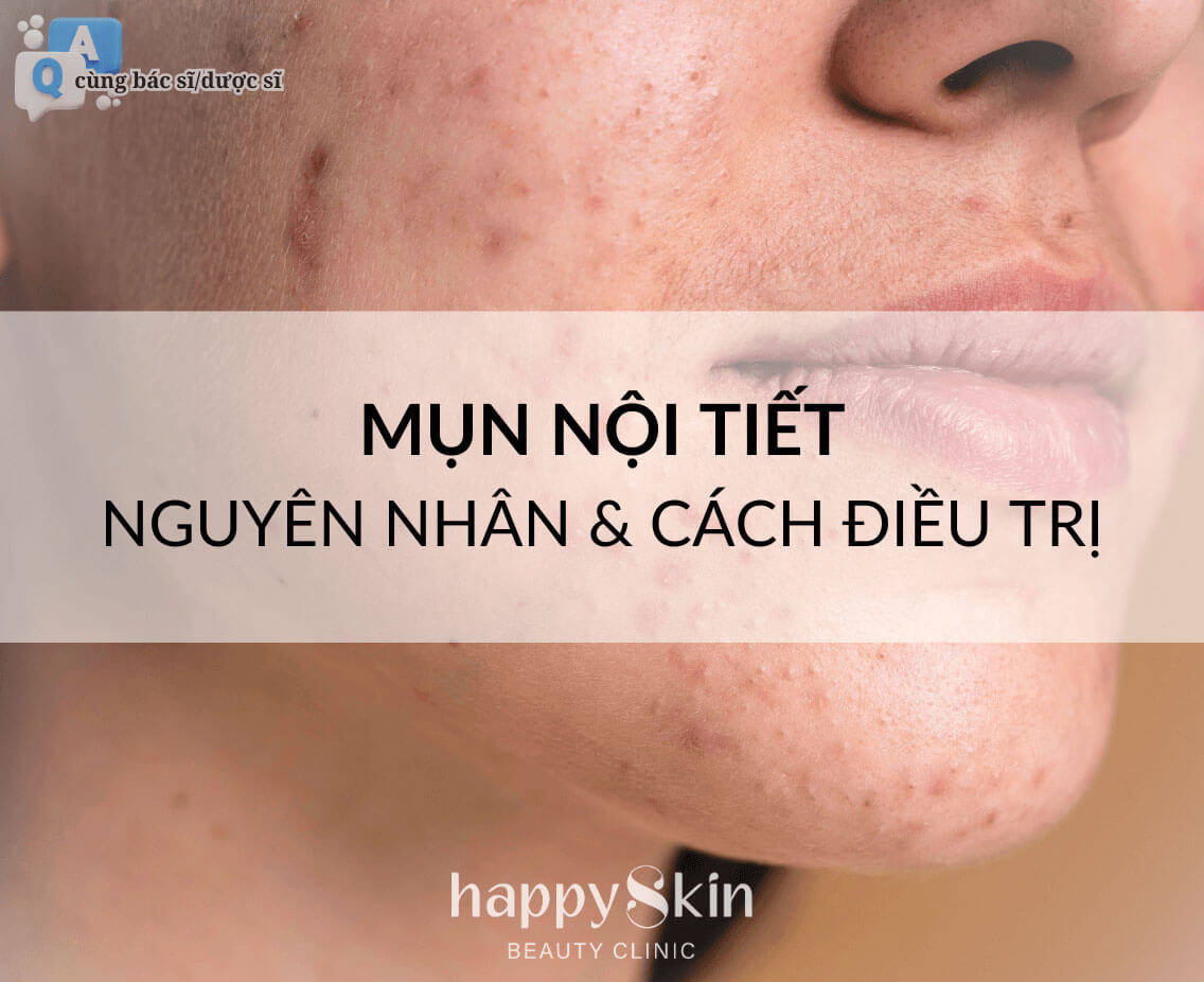 Làm Đẹp Cùng Bác Sĩ - Kỳ 5: Mụn Nội Tiết??? Đừng Quá Lo Lắng Khi Bạn Đọc Bài Viết Này