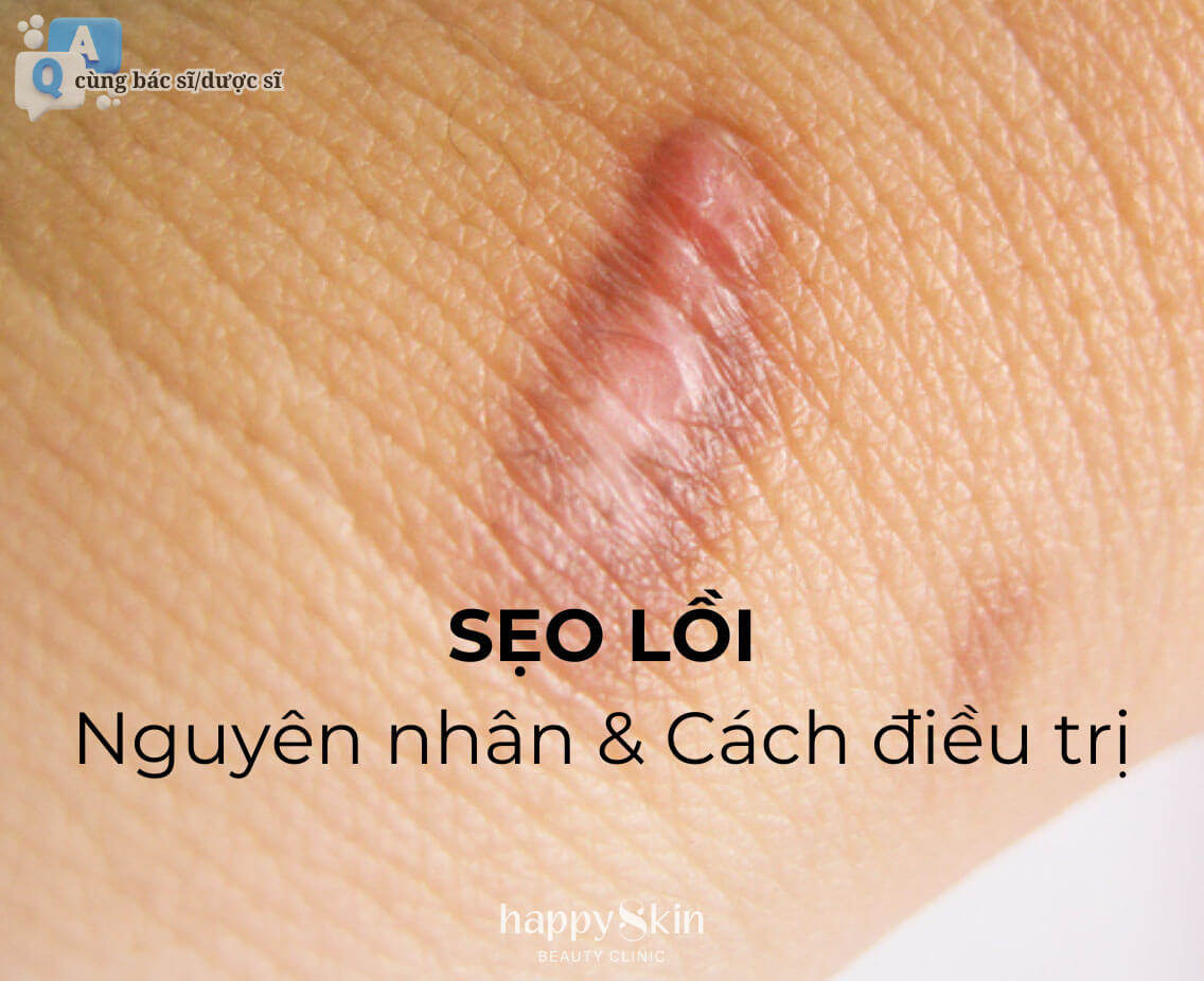 Làm Đẹp Cùng Bác Sĩ - Kỳ 7: Sẹo Lồi - Nguyên Nhân Và Cách Điều Trị Từ Bác Sĩ