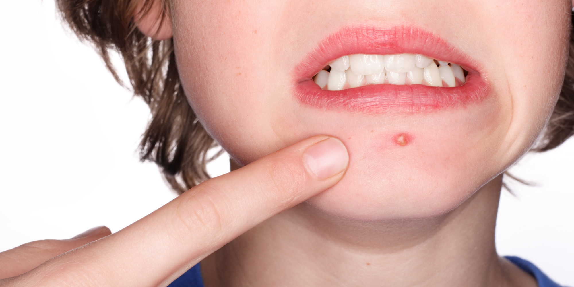 13 nguyên nhân gây mụn bạn không ngờ tới