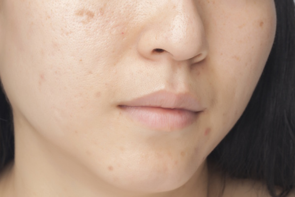 Cẩm Nang Trị Thâm Mụn
