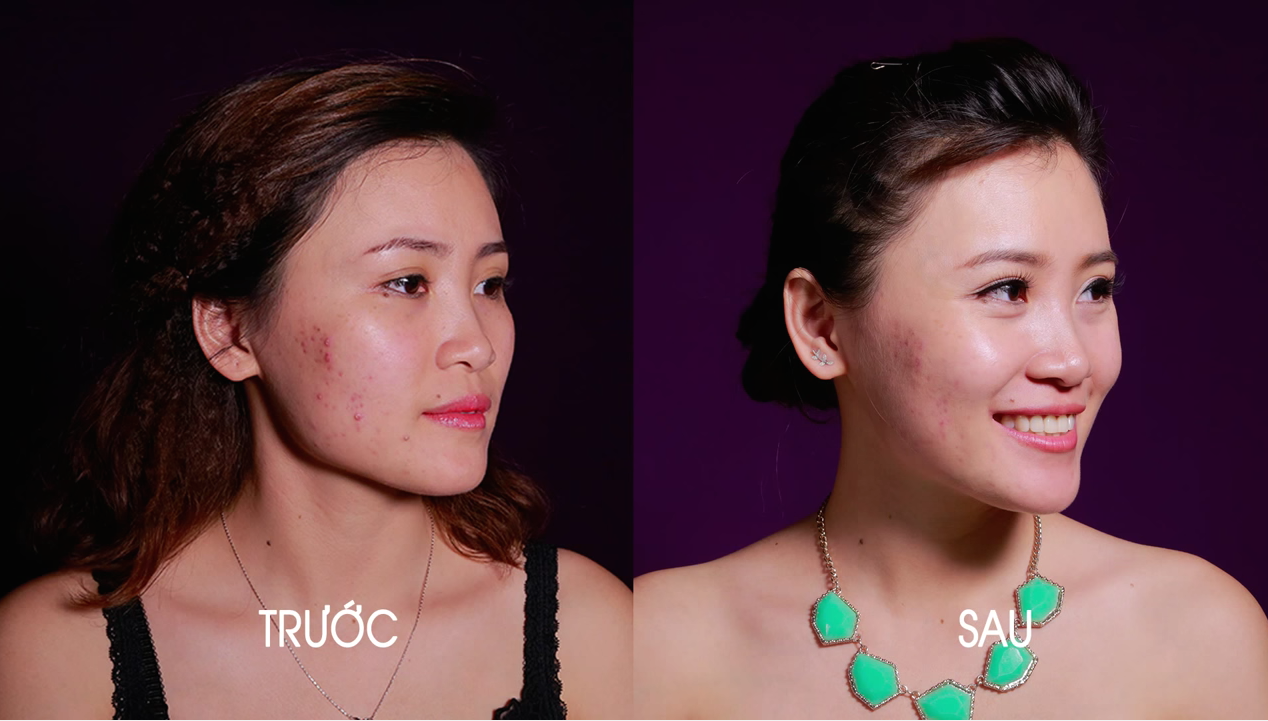 Tôi Đã Lấy Lại Tự Tin Thế Nào Khi Trị Mụn Và Vết Thâm Bằng Laser?